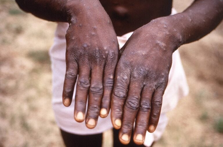 DRC - WHO - HEALTH - VIRUS - MONKEYPOX